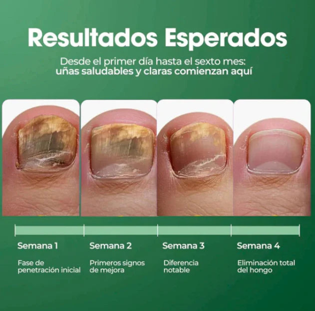 Terbinafina 🦶 | El aceite que elimina los hongos de tus uñas 🌿