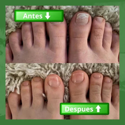 Terbinafina 🦶 | El aceite que elimina los hongos de tus uñas 🌿